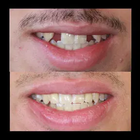 Home | West Ajax dental 27 home-page-beforeandafter14-288x288
