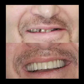 Home | West Ajax dental 22 home-page-beforeandafter6-288x288