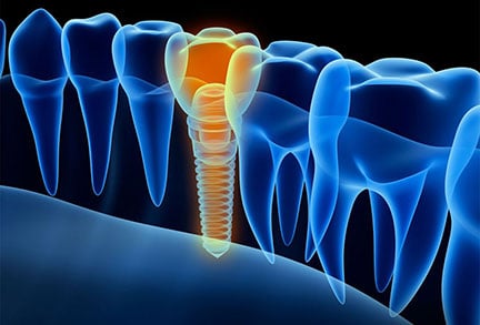 Computer-Guided Dental Implants