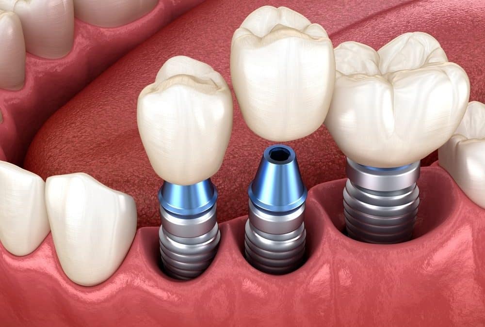 What is an Immediate Dental Implant?
