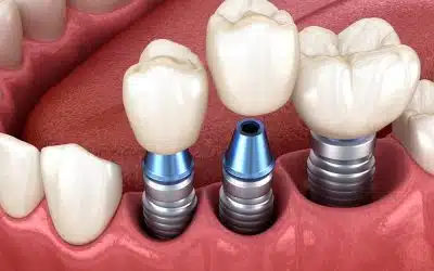 What is an Immediate Dental Implant?