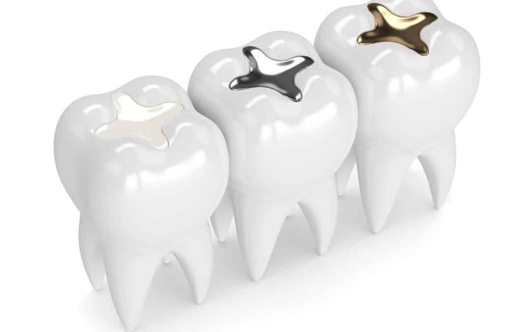 What are the differences between Amalgam and White Fillings?