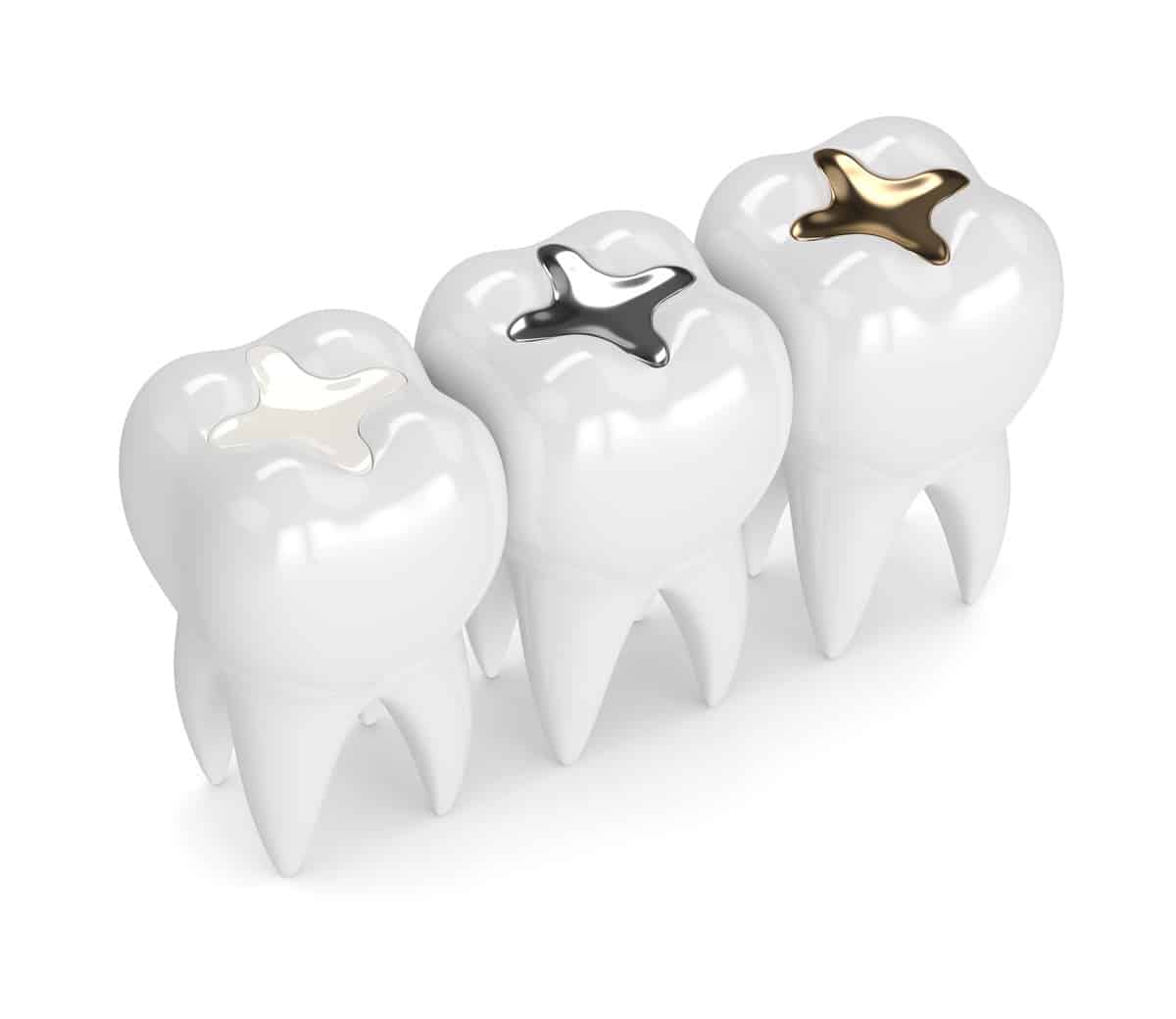 What are the differences between Amalgam and White Fillings? West