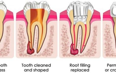 What risks are associated with delaying a root canal therapy?