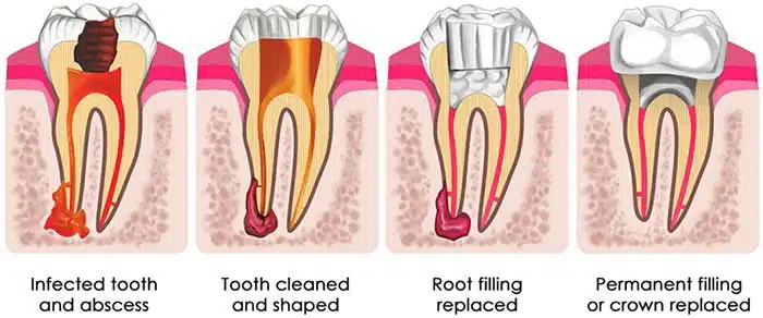 What risks are associated with delaying a root canal therapy?