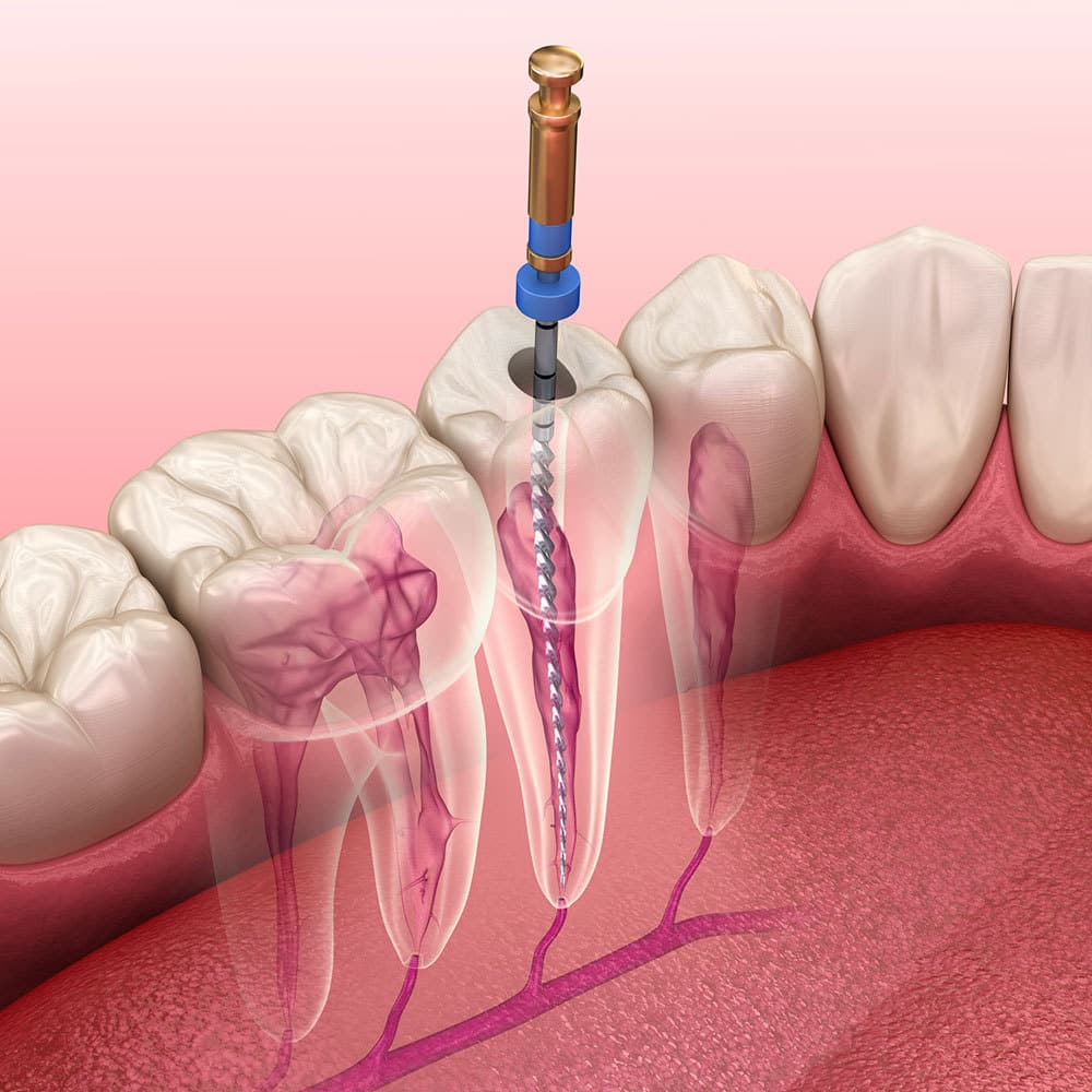 Endodontics 2
